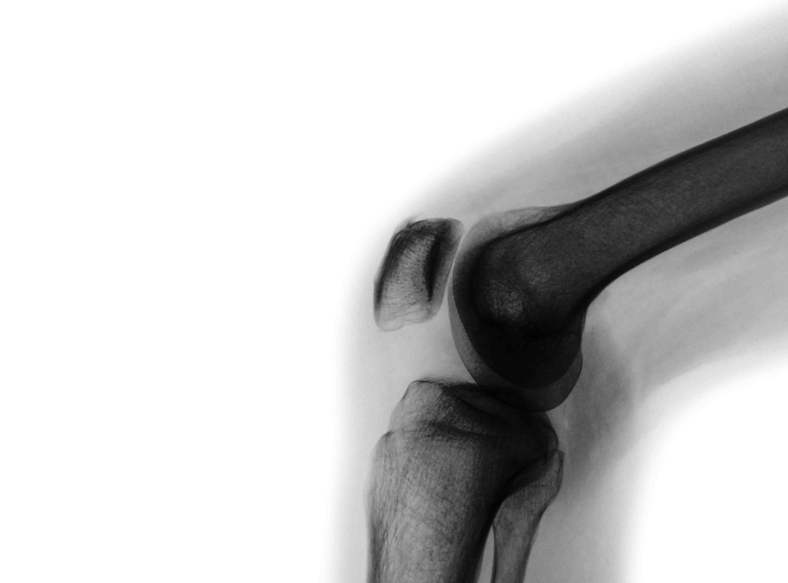 Osteoarthritis GLAD GLA:D